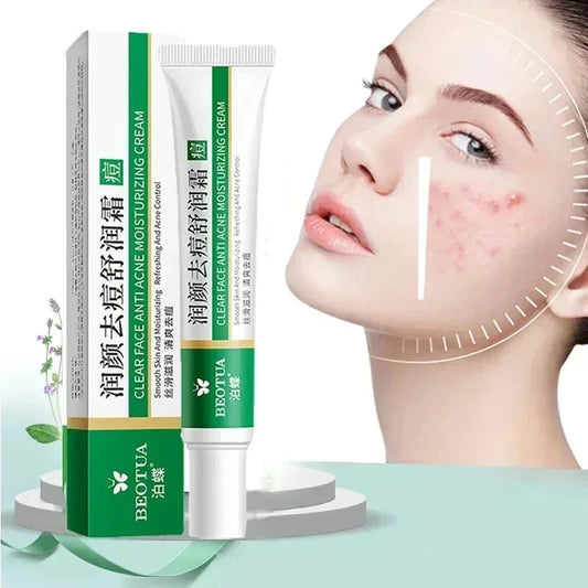 Korean Acne Care Gel – Clear Pores & Healthy Glow