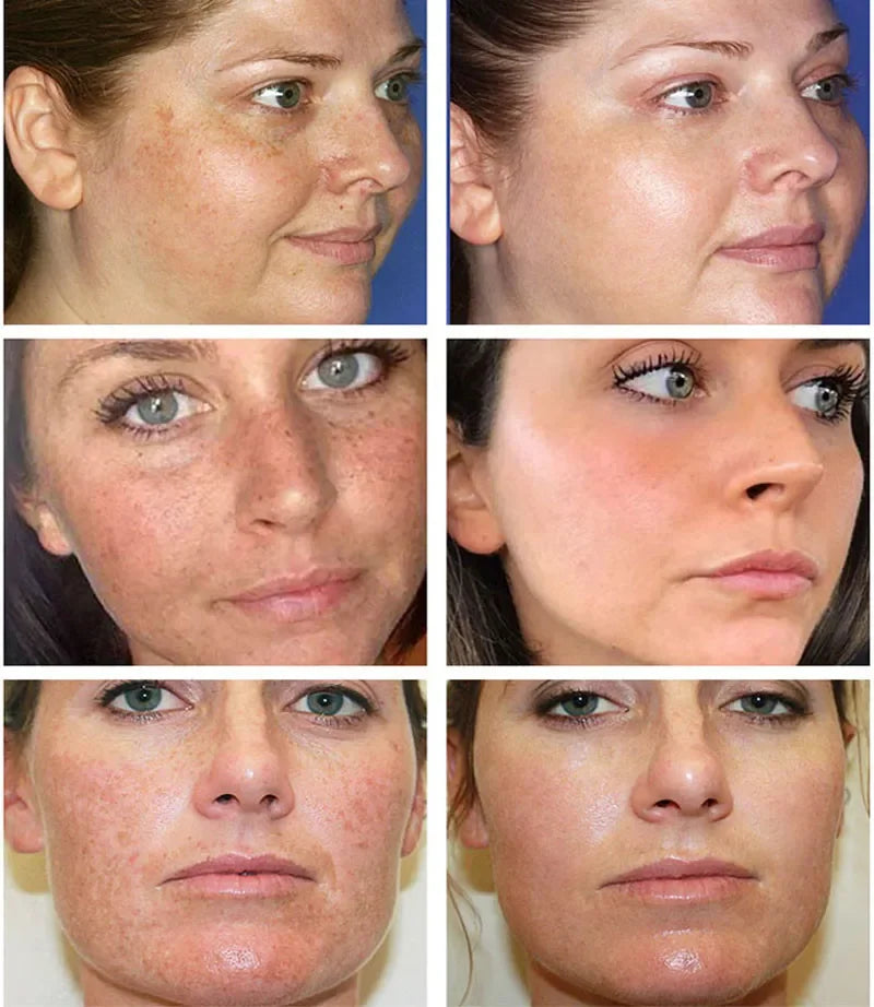 Clinical Pigment Corrector Cream – Melasma & Dark Spot Repair